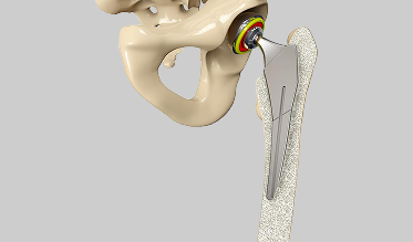hip-replacement hip-replacement